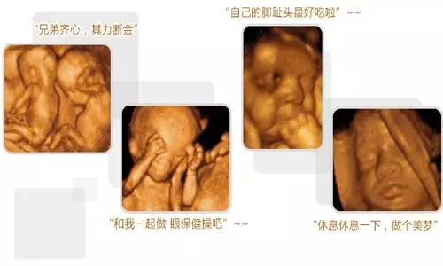 孕期四维彩超解读：胎儿健筛查全攻略