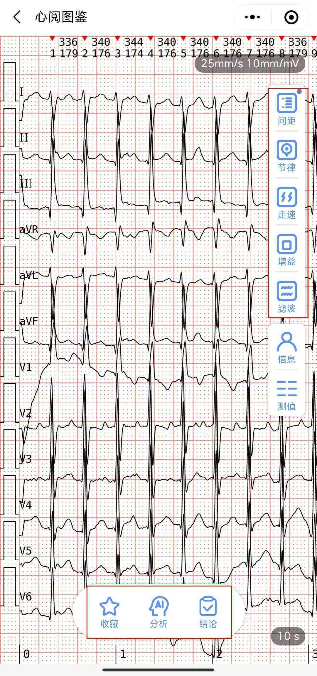 心电ai报告